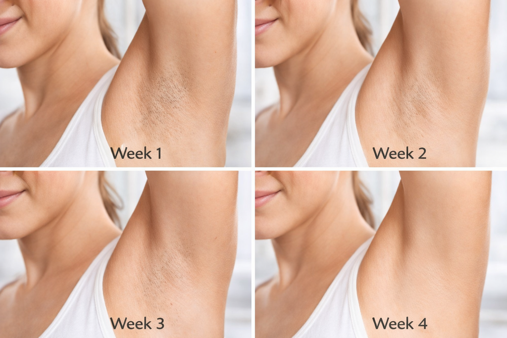 LaserVela™ IPL – Long Term Hair Reduction