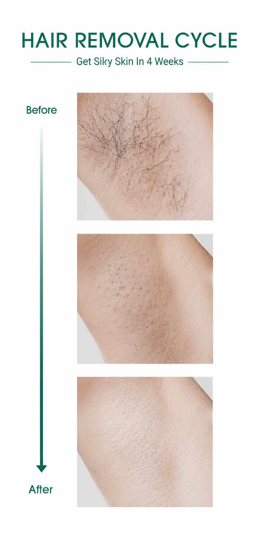 LaserVela™ IPL – Long Term Hair Reduction