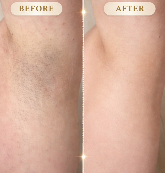 LaserVela™ IPL – Long Term Hair Reduction
